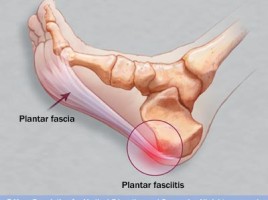 plantar_fasciitis