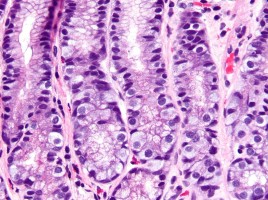 800px-G_cell_hyperplasia_-_very_high_mag