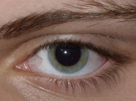 800px-Result_of_Dilated_fundus_examination